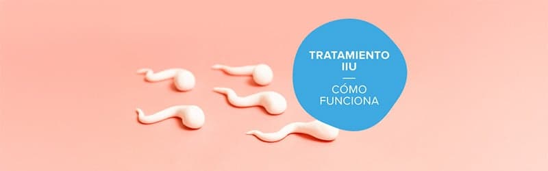 ¿Qué es un tratamiento IUI? ¿Qué es un tratamiento IUI?
