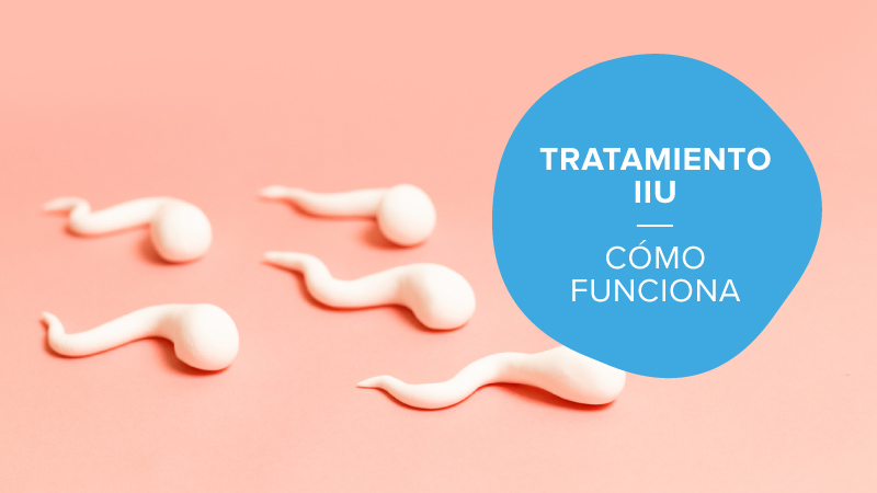 ¿Qué es un tratamiento IUI?
