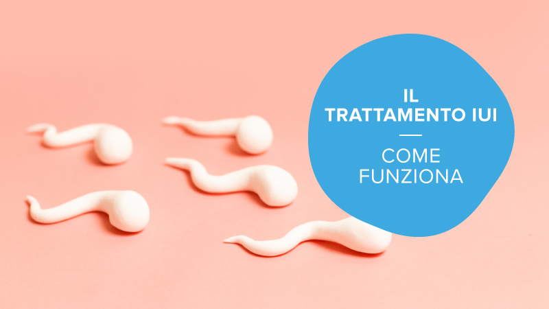 Che cos'è il trattamento IUI?