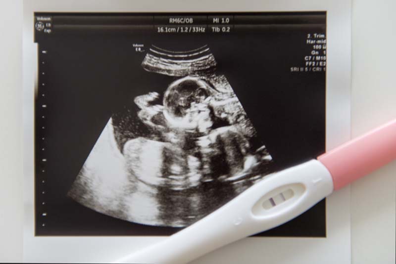 An ultrasound showing twins