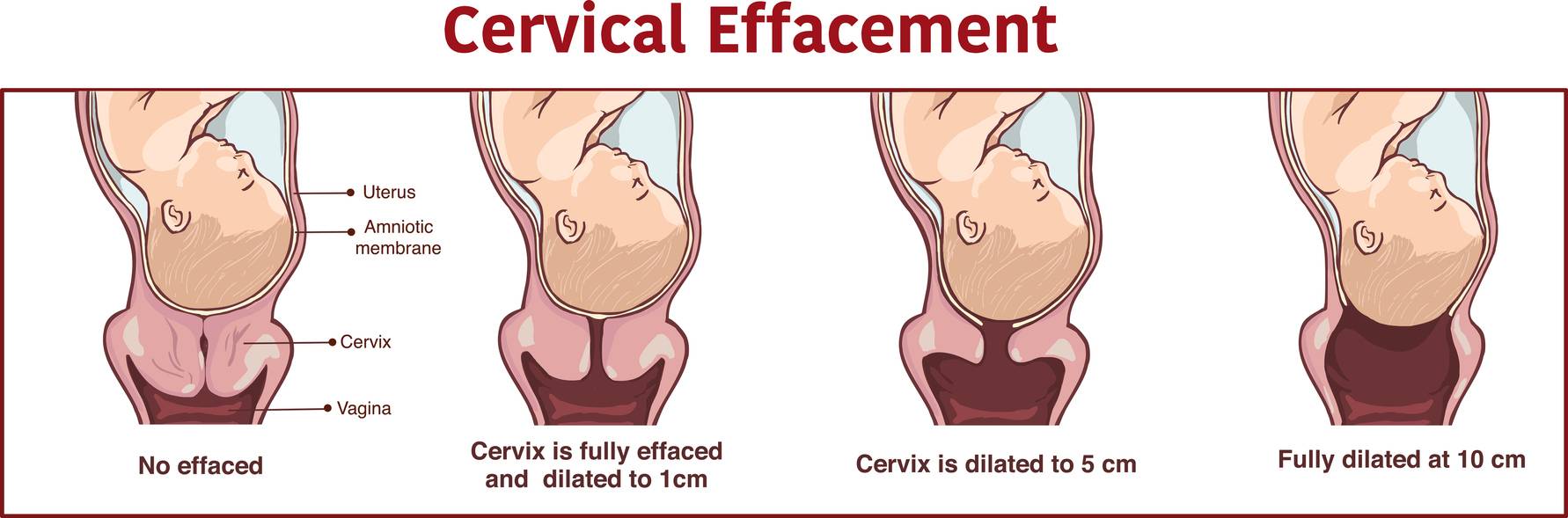 An illustration of the cervical effacement that happens during labour