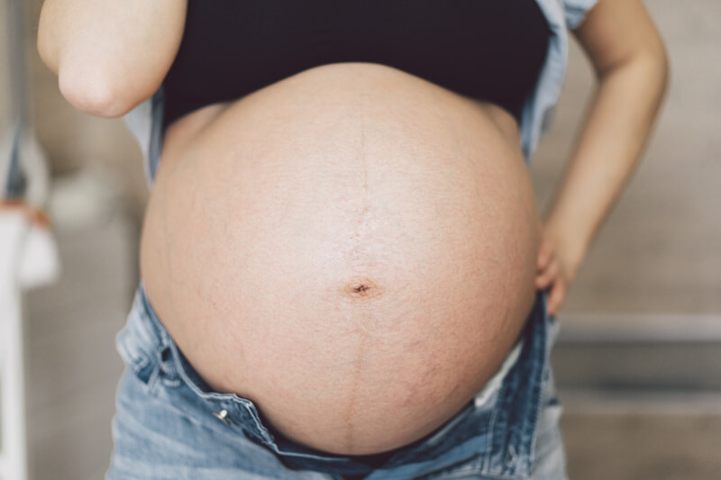 Midwife explains that creams and oils have no effect on stretch marks
