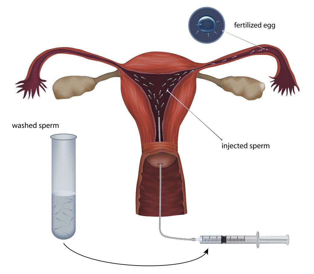 An illustration of an insemination with IUI ready sperm