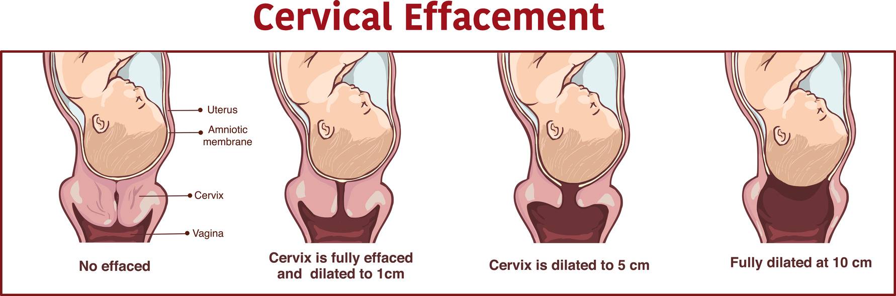 Illustration de l’effacement cervical qui se produit pendant le travail 