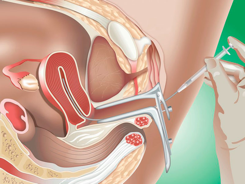 IUI - Intrauterine Insemination is another infertility treatment option