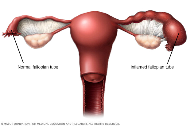 Pelvic Inflammatory Disease Cryos International Sperm and Egg Bank