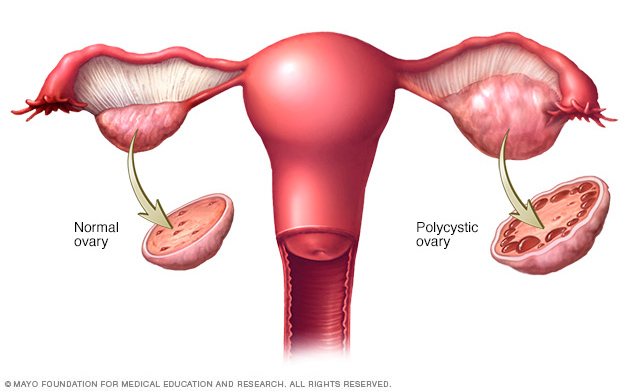 Polycystic Ovary Syndrome Cryos International Sperm and Egg Bank